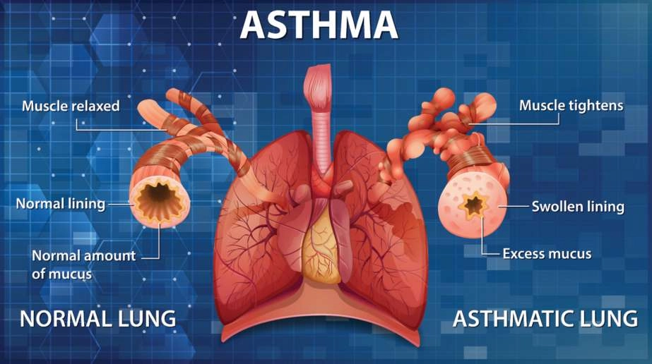 Can You Play Soccer if You Have Asthma? The Truth